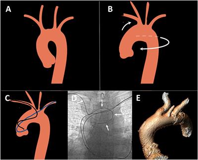 Left vs. right radial approach for coronary catheterization: Relation to age and severe aortic stenosis
